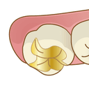 上奥歯
